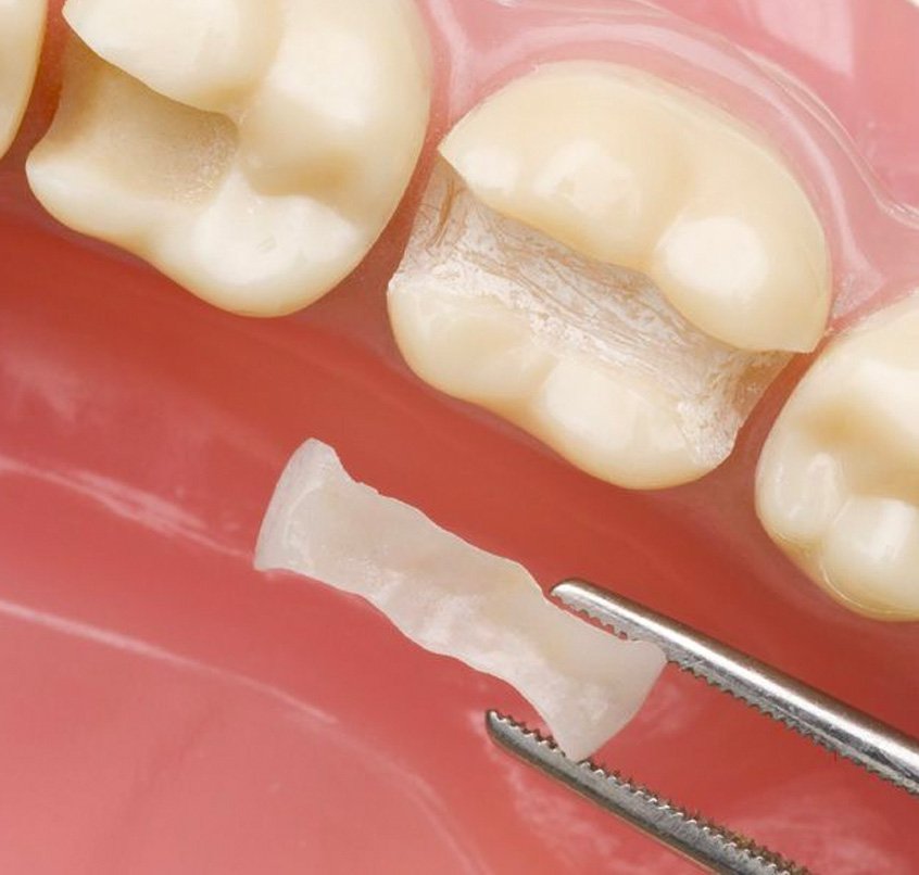 Restoratif Diş Tedavisi